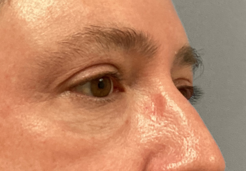 BLEPHAROPLASTY Before & After Gallery - Patient 344008 - Image 3