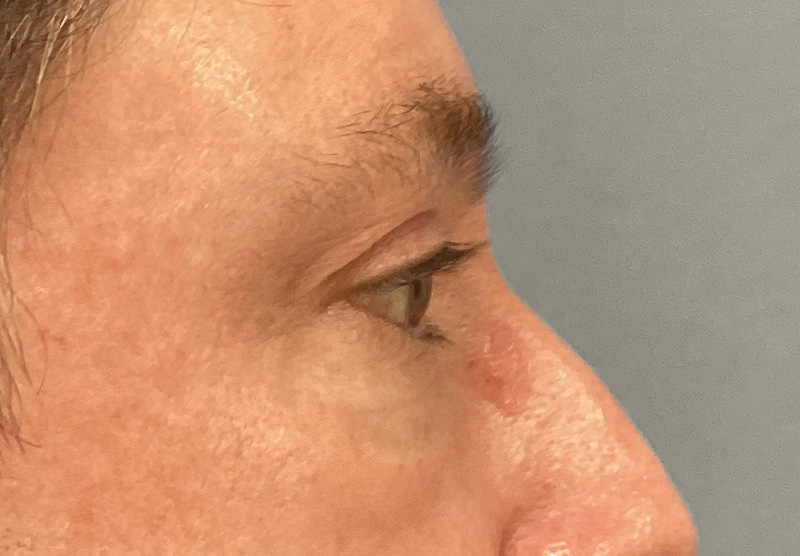 BLEPHAROPLASTY Before & After Gallery - Patient 344008 - Image 5
