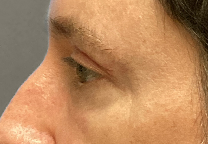 BLEPHAROPLASTY Before & After Gallery - Patient 344008 - Image 10