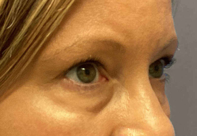 BLEPHAROPLASTY Before & After Gallery - Patient 379676 - Image 3