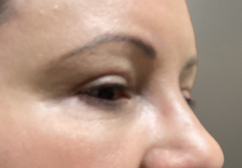 BLEPHAROPLASTY Before & After Gallery - Patient 379676 - Image 4