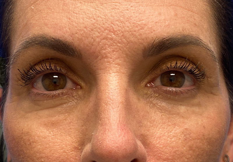 BLEPHAROPLASTY Before & After Gallery - Patient 388287 - Image 2