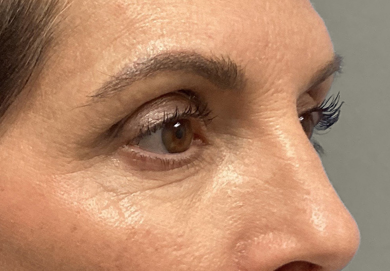 BLEPHAROPLASTY Before & After Gallery - Patient 388287 - Image 3