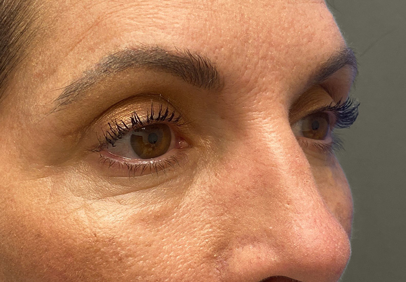 BLEPHAROPLASTY Before & After Gallery - Patient 388287 - Image 4