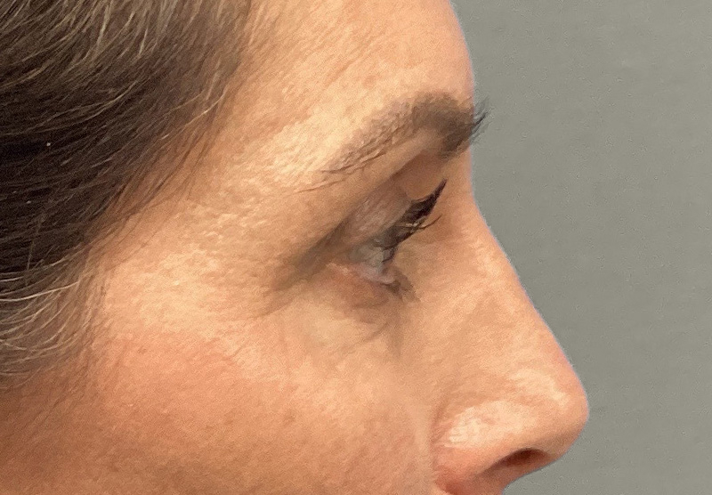 BLEPHAROPLASTY Before & After Gallery - Patient 388287 - Image 5
