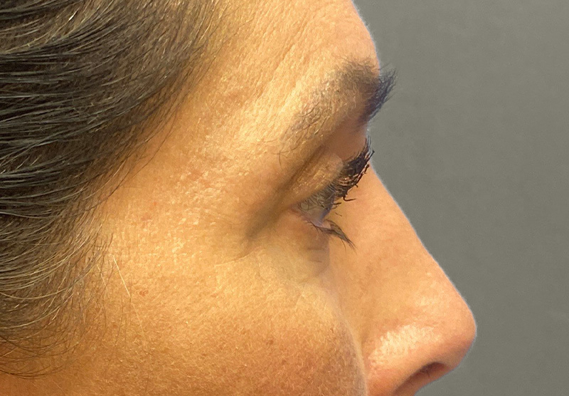BLEPHAROPLASTY Before & After Gallery - Patient 388287 - Image 6