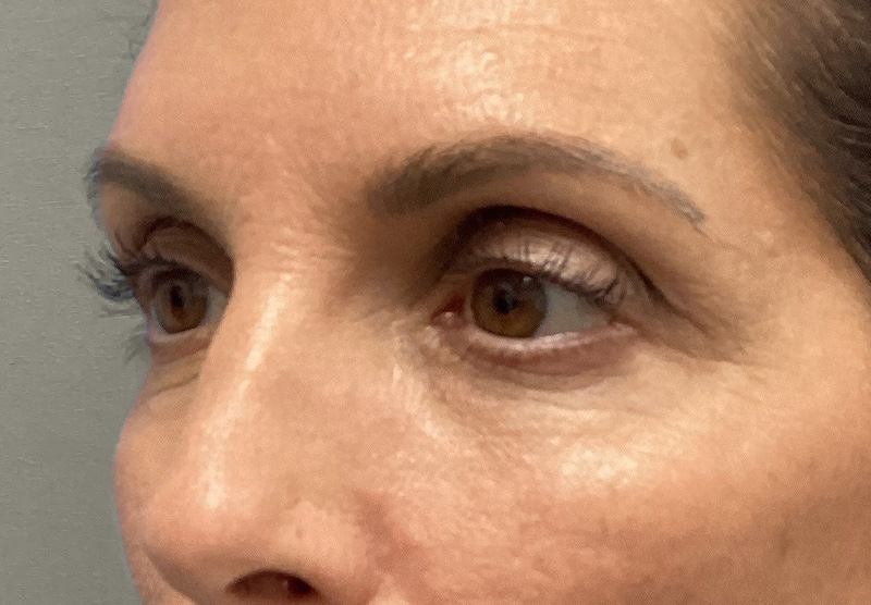BLEPHAROPLASTY Before & After Gallery - Patient 388287 - Image 7