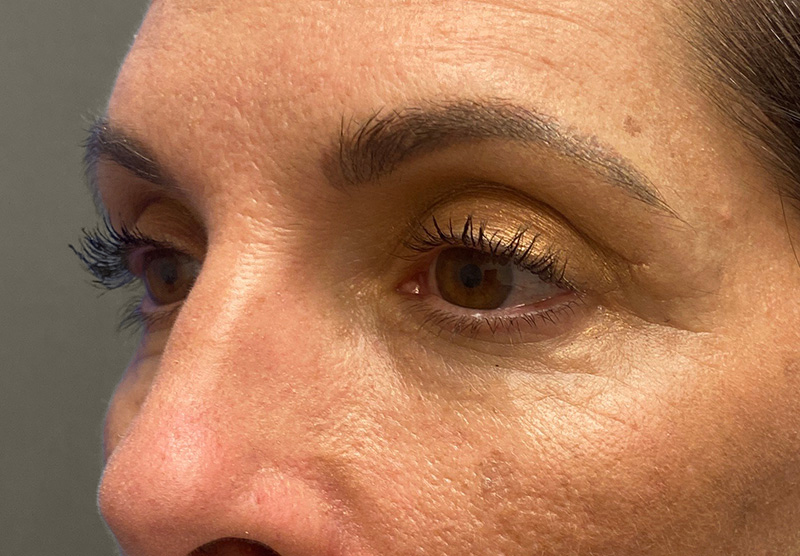 BLEPHAROPLASTY Before & After Gallery - Patient 388287 - Image 8