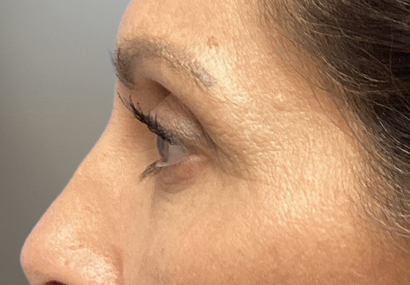 BLEPHAROPLASTY Before & After Gallery - Patient 388287 - Image 9