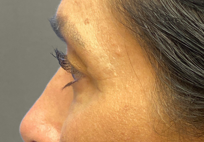 BLEPHAROPLASTY Before & After Gallery - Patient 388287 - Image 10