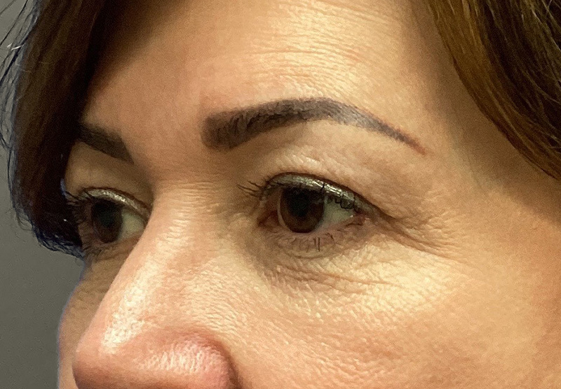 BLEPHAROPLASTY Before & After Gallery - Patient 419971 - Image 7