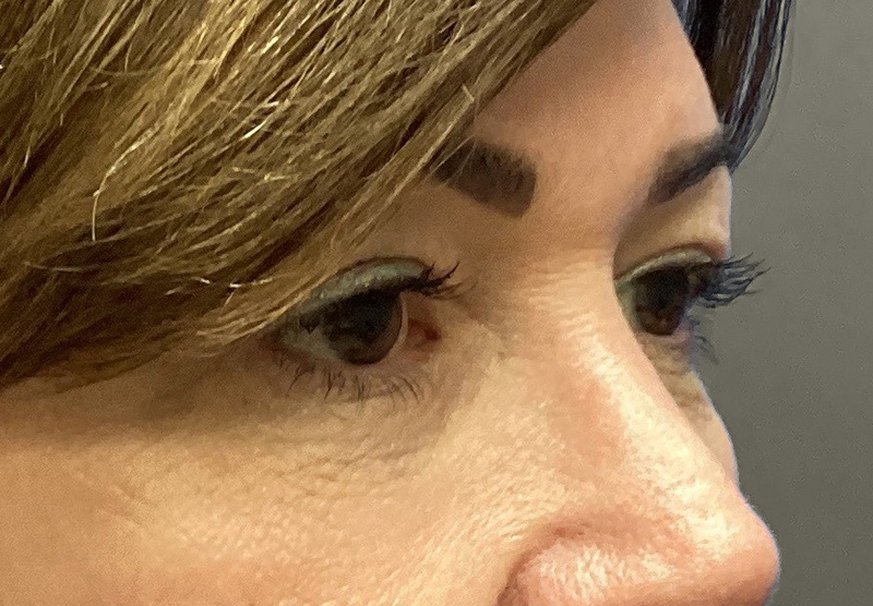 BLEPHAROPLASTY Before & After Gallery - Patient 419971 - Image 3