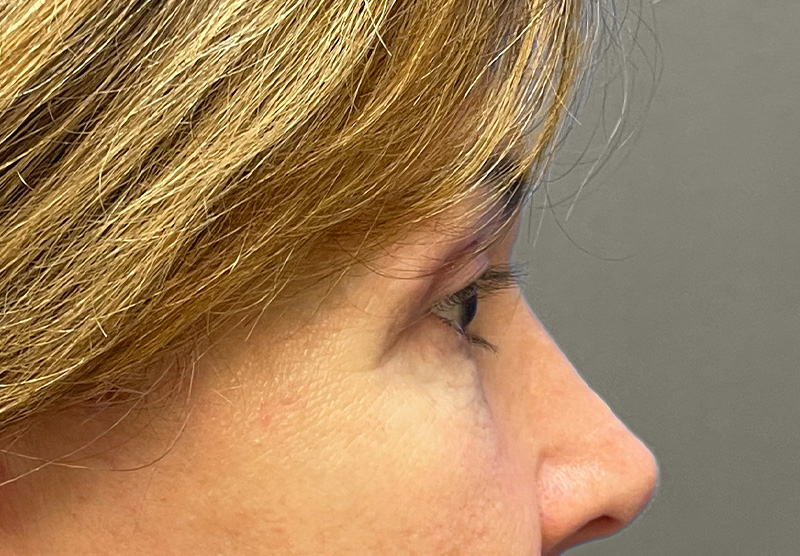 BLEPHAROPLASTY Before & After Gallery - Patient 419971 - Image 6