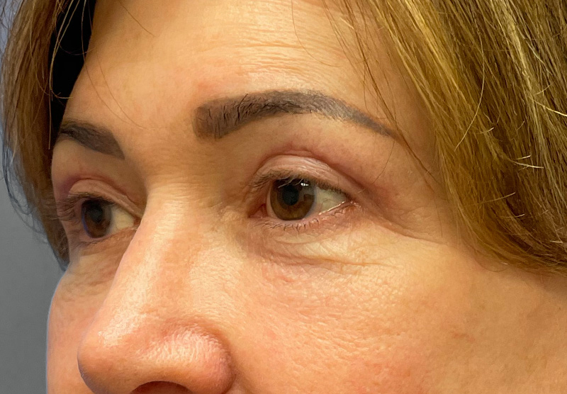 BLEPHAROPLASTY Before & After Gallery - Patient 419971 - Image 8
