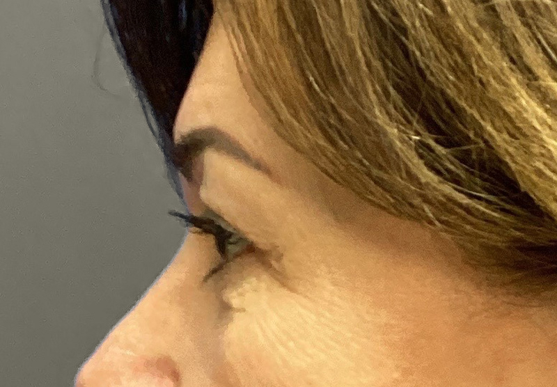 BLEPHAROPLASTY Before & After Gallery - Patient 419971 - Image 9