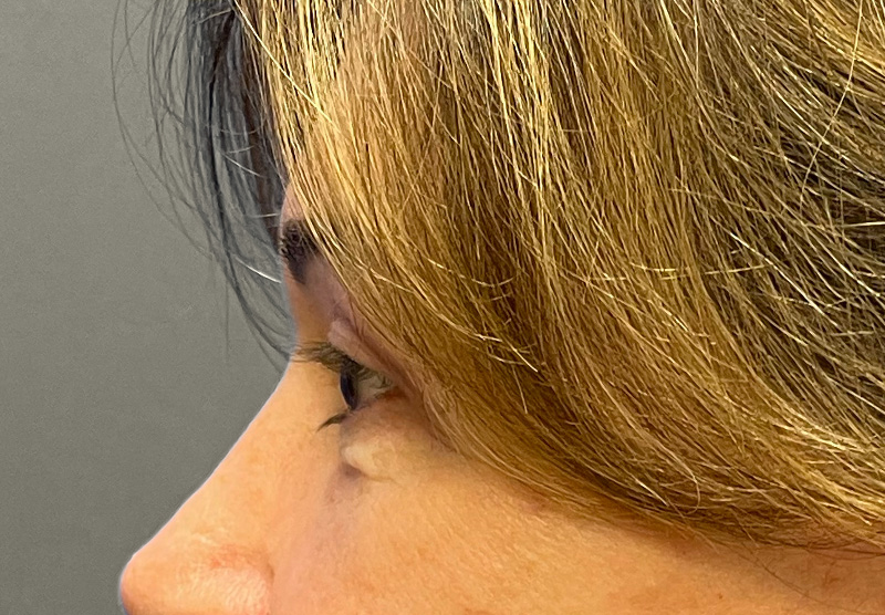 BLEPHAROPLASTY Before & After Gallery - Patient 419971 - Image 10