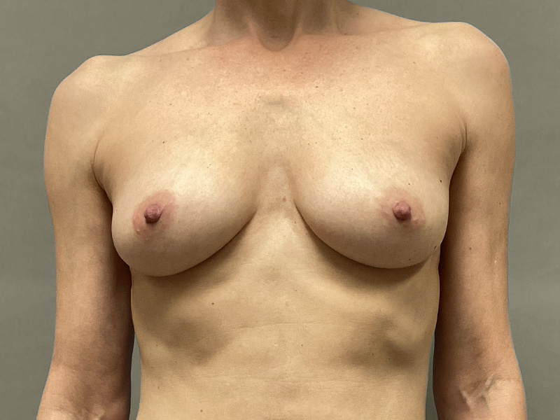 BREAST AUGMENTATION Before & After Gallery - Patient 150845 - Image 1