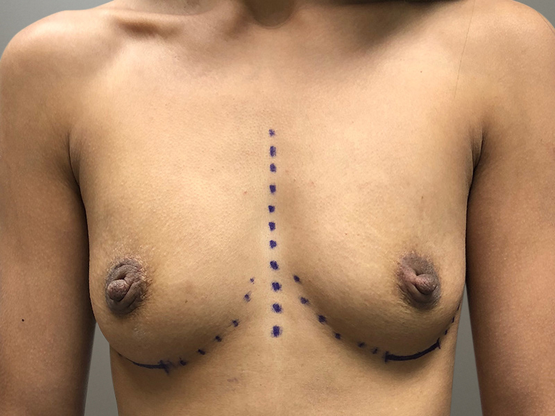BREAST AUGMENTATION Before & After Gallery - Patient 252897 - Image 1