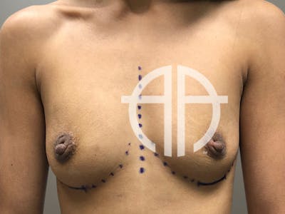 BREAST AUGMENTATION Before & After Gallery - Patient 252897 - Image 1
