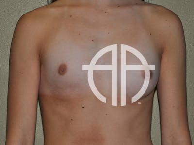 BREAST AUGMENTATION Before & After Gallery - Patient 265070 - Image 1