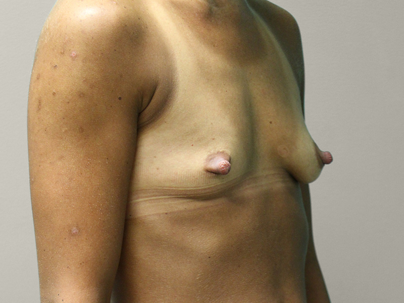 BREAST AUGMENTATION Before & After Gallery - Patient 317022 - Image 3