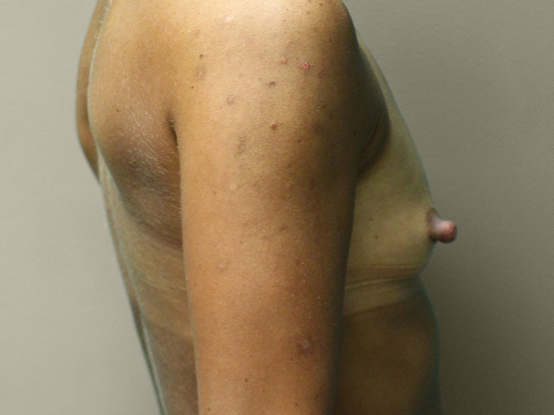 BREAST AUGMENTATION Before & After Gallery - Patient 317022 - Image 5