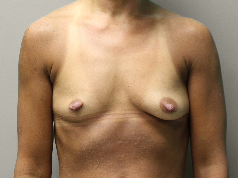 BREAST AUGMENTATION Before & After Gallery - Patient 317022 - Image 1