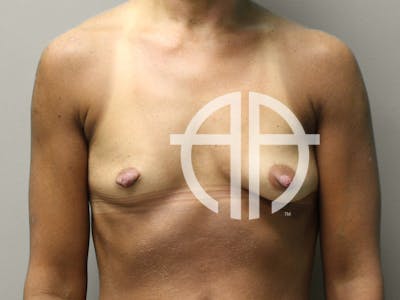 BREAST AUGMENTATION Before & After Gallery - Patient 317022 - Image 1