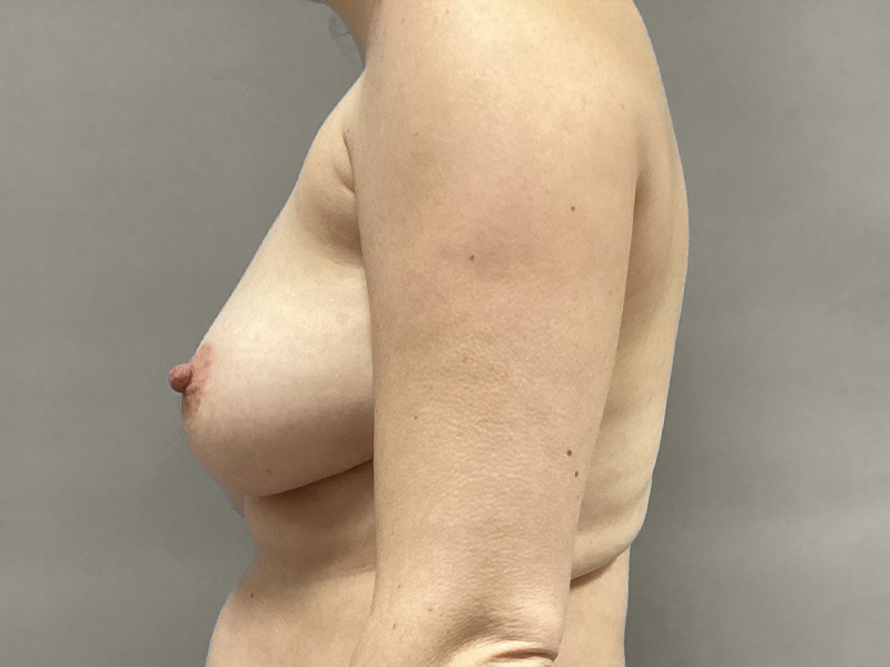 BREAST LIFT Before & After Gallery - Patient 966786 - Image 5