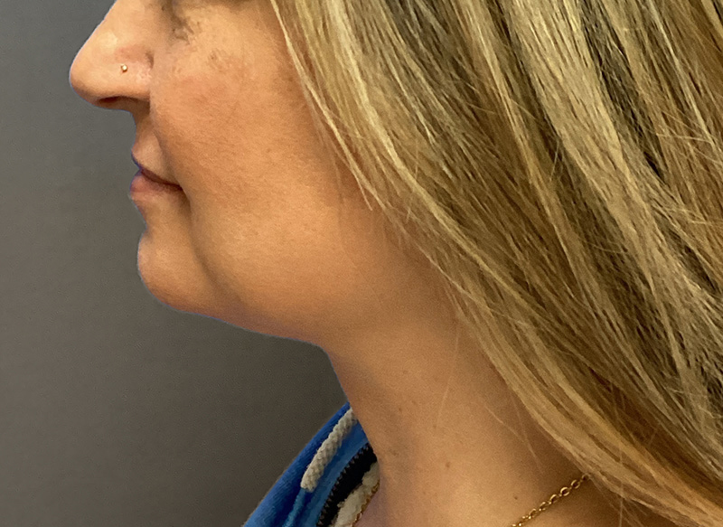 SUBMENTAL LIPOSUCTION Before & After Gallery - Patient 233653 - Image 2