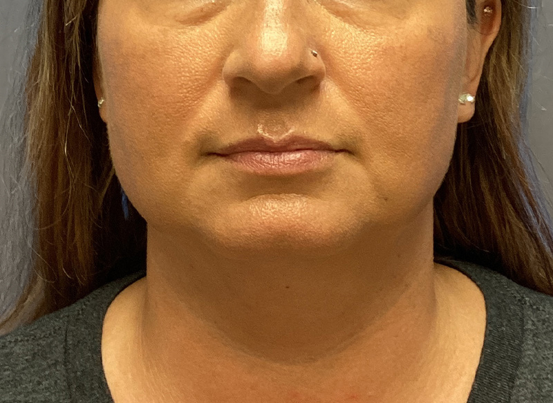 SUBMENTAL LIPOSUCTION Before & After Gallery - Patient 233653 - Image 3