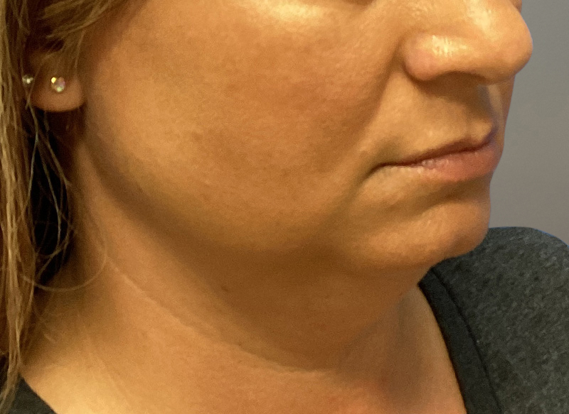 SUBMENTAL LIPOSUCTION Before & After Gallery - Patient 233653 - Image 5