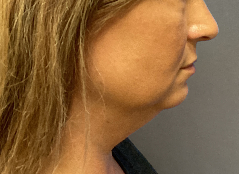 SUBMENTAL LIPOSUCTION Before & After Gallery - Patient 233653 - Image 7