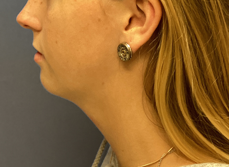 SUBMENTAL LIPOSUCTION Before & After Gallery - Patient 281364 - Image 1