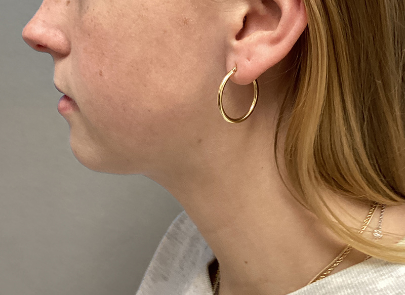 SUBMENTAL LIPOSUCTION Before & After Gallery - Patient 281364 - Image 2