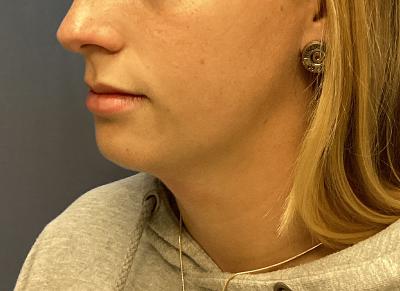 SUBMENTAL LIPOSUCTION Before & After Gallery - Patient 281364 - Image 3