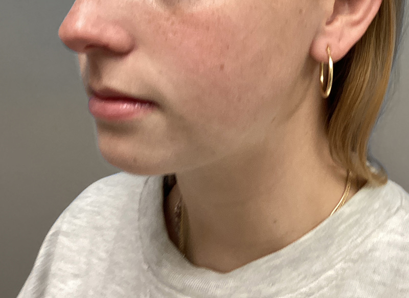 SUBMENTAL LIPOSUCTION Before & After Gallery - Patient 281364 - Image 4