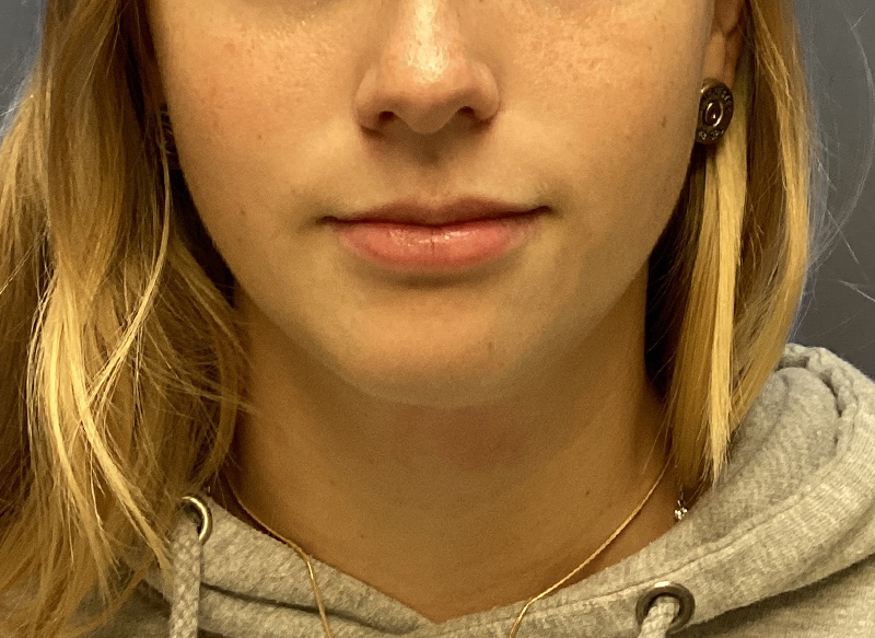 SUBMENTAL LIPOSUCTION Before & After Gallery - Patient 281364 - Image 5