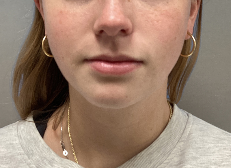 SUBMENTAL LIPOSUCTION Before & After Gallery - Patient 281364 - Image 6