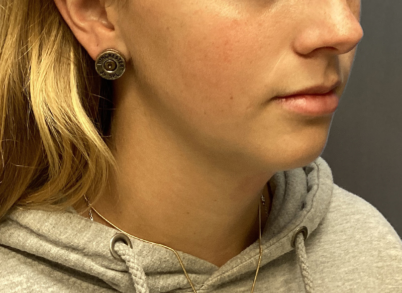 SUBMENTAL LIPOSUCTION Before & After Gallery - Patient 281364 - Image 7