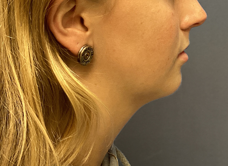 SUBMENTAL LIPOSUCTION Before & After Gallery - Patient 281364 - Image 9