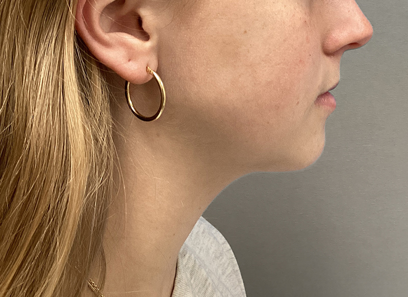 SUBMENTAL LIPOSUCTION Before & After Gallery - Patient 281364 - Image 10