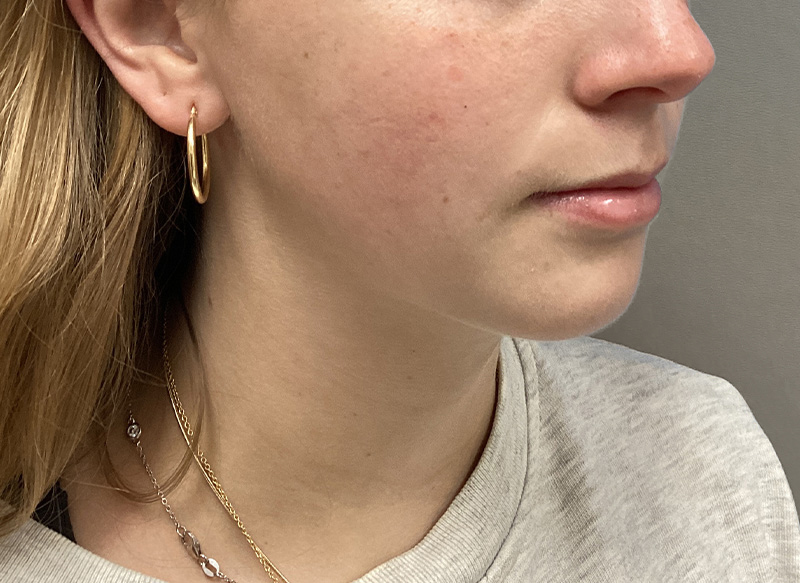 SUBMENTAL LIPOSUCTION Before & After Gallery - Patient 281364 - Image 8