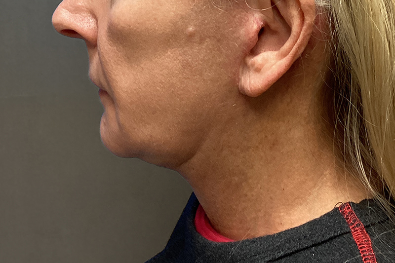 SUBMENTAL LIPOSUCTION Before & After Gallery - Patient 285408 - Image 1