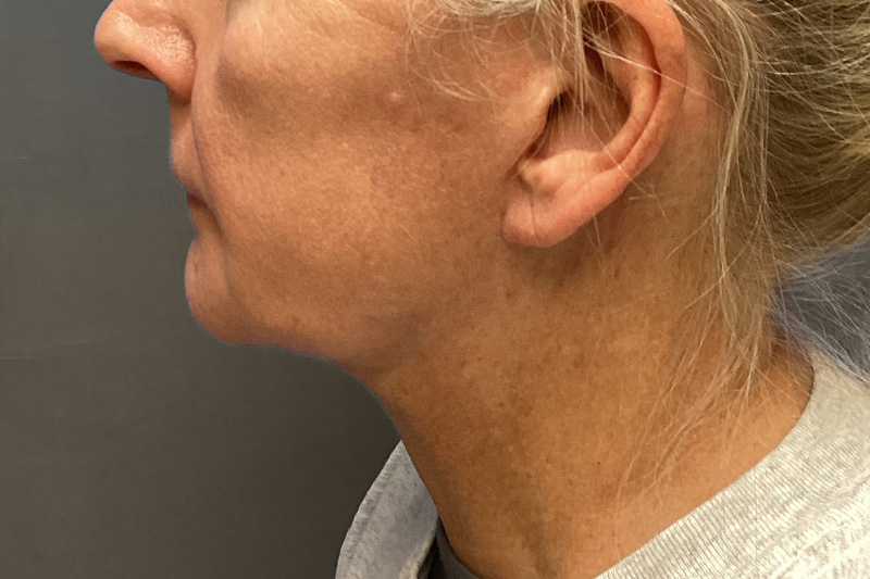 SUBMENTAL LIPOSUCTION Before & After Gallery - Patient 285408 - Image 2