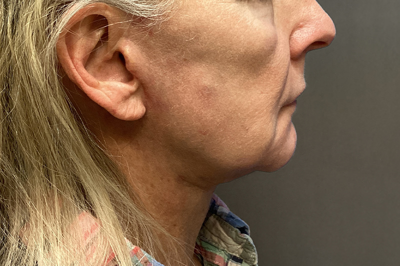 SUBMENTAL LIPOSUCTION Before & After Gallery - Patient 285408 - Image 3