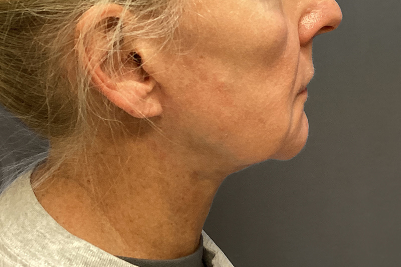 SUBMENTAL LIPOSUCTION Before & After Gallery - Patient 285408 - Image 4