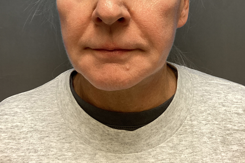 SUBMENTAL LIPOSUCTION Before & After Gallery - Patient 285408 - Image 6