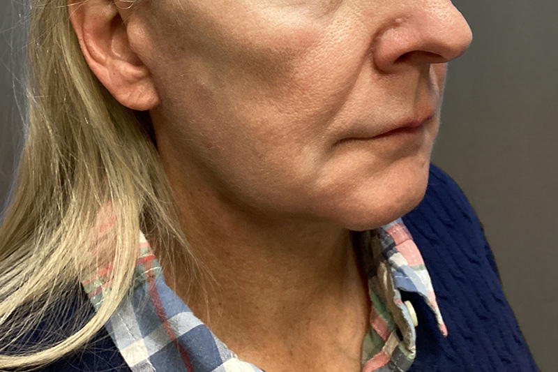 SUBMENTAL LIPOSUCTION Before & After Gallery - Patient 285408 - Image 7