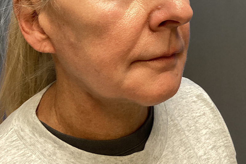 SUBMENTAL LIPOSUCTION Before & After Gallery - Patient 285408 - Image 8